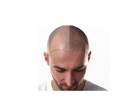 Best clinic for hair transplant in Kenton London