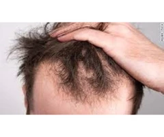 Best clinic for hair loss in London