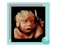 Get The Best 4D Baby Scans From Private Ultrasound Scan In Aylesbury Clinic