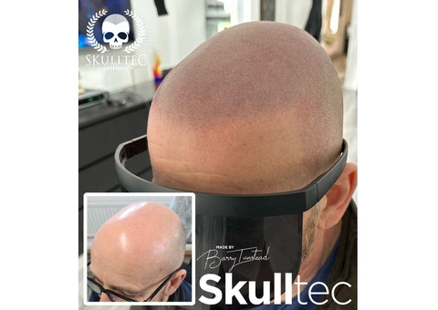 Scalp Micropigmentation Before & After