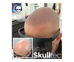 Scalp Micropigmentation Before & After
