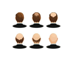 Hire a Professional to Get Balding Treatment in New Jersey