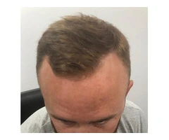 The Best Hair Transplant without Shaving London, UK
