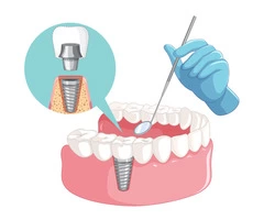 Facts Regarding Dental Implants