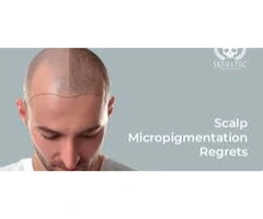 Scalp Micropigmentation Regrets