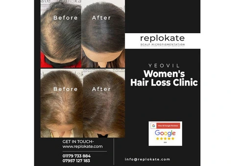 Treating Women's Hair Loss with Scalp Micropigmentation